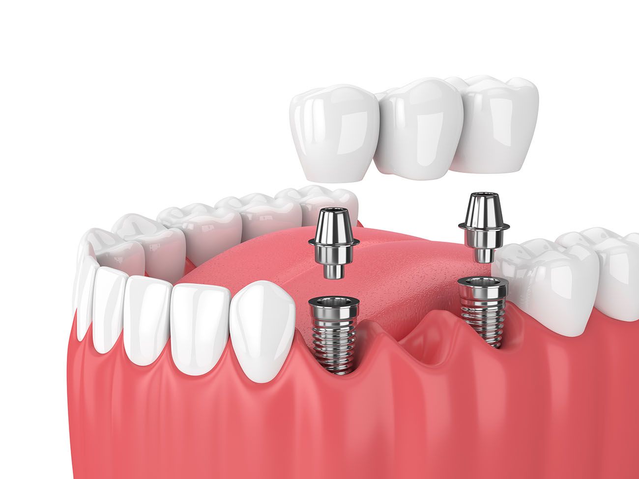 Removable or Fixed Dental Bridges? - Dentist in Suffolk, VA